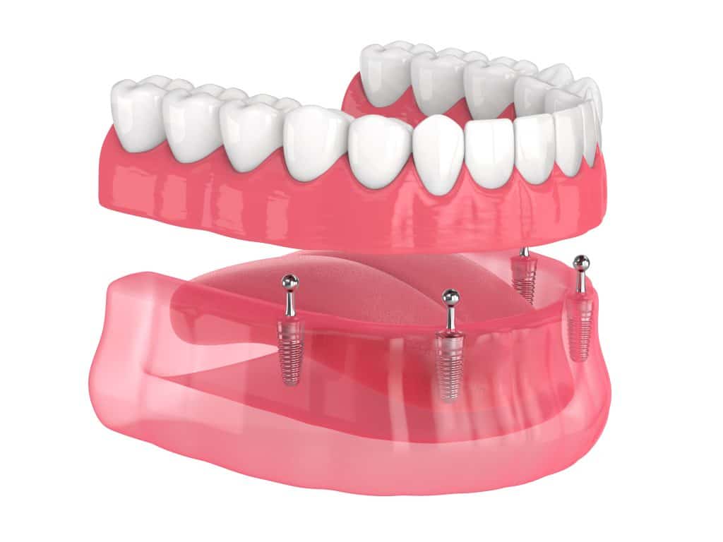 Implant-Supported Dentures Washington, MO