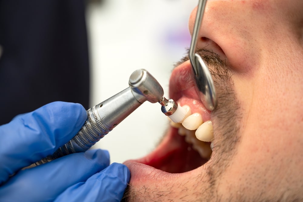 Dental Cleanings Washington